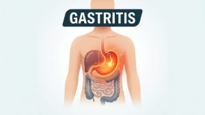 Gastritis: 6 mitova koji vam produžavaju tegobe